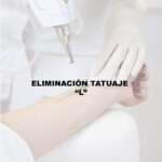 ELIMINACION TATUAJE "L"